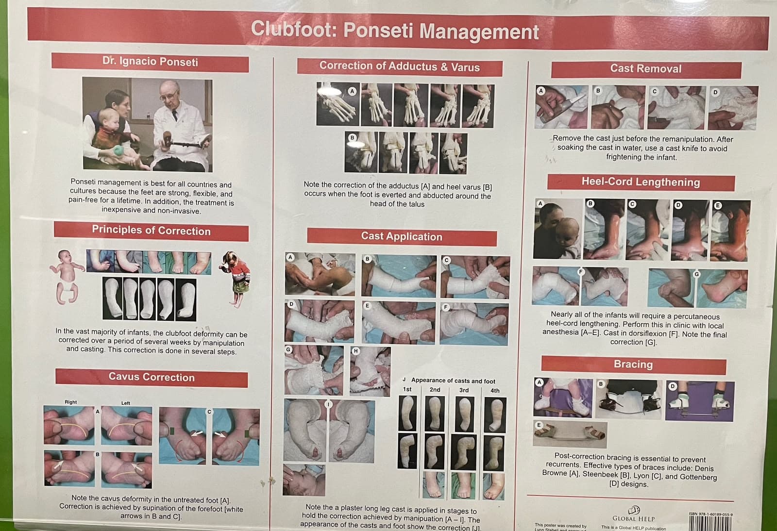 Clinical teaching poster showing stages of Ponseti clubfoot management, including correction principles, serial cast application, cast removal, Achilles tenotomy and foot-abduction bracing.